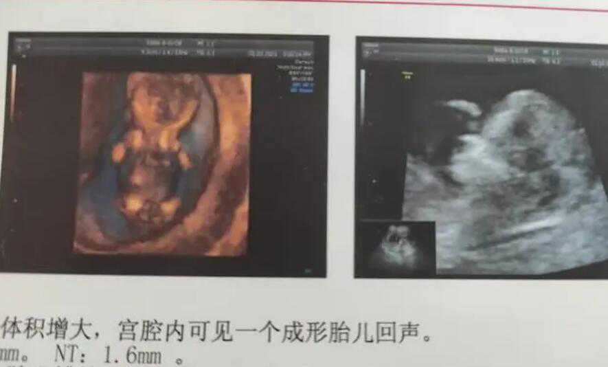 云南昆明爱维爱夫医院_孕宝助孕_做试管婴儿成功“好孕”，我用的是长方案
