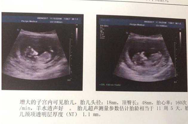 福婴国际助孕华南区_试管婴儿第一代_西藏阜康第三代试管婴儿成功率能达45%吗